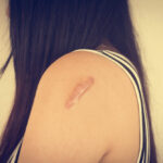 mengatasi keloid