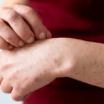 scabies