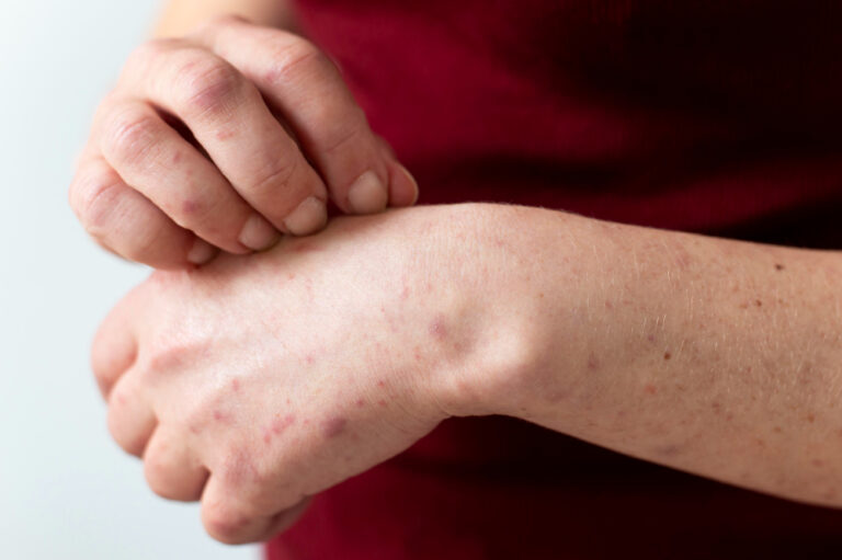 scabies