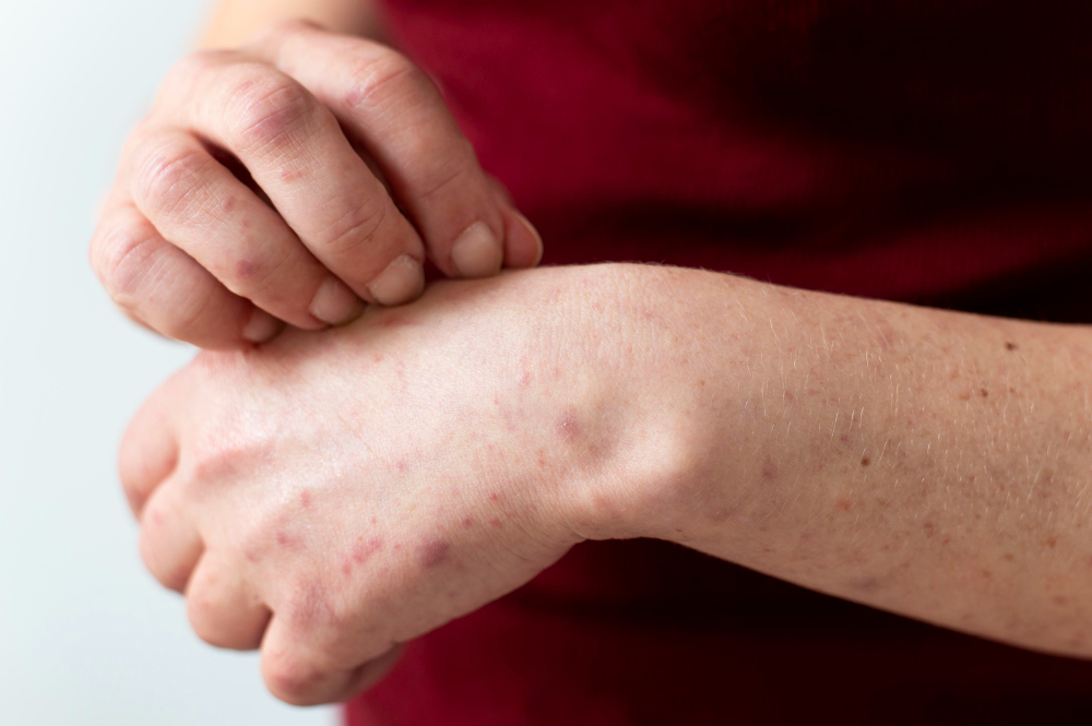 Scabies: Apa Itu dan Bagaimana Cara Mengatasinya?