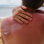 Sunburn
